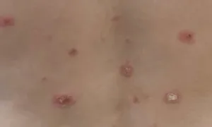 Trẻ bệnh vảy nến có chữa bằng thuốc sinh học được không? Trẻ bệnh vảy nến có chữa bằng thuốc sinh học được không?