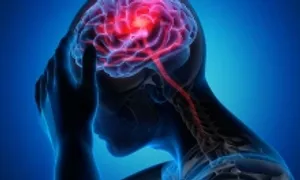 Đột quỵ gia tăng ở người trẻ toàn thế giới Đột quỵ gia tăng ở người trẻ toàn thế giới