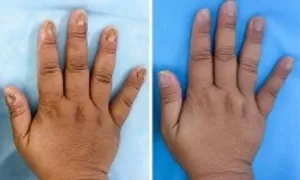 Nấm làm biến dạng móng tay chân người phụ nữ Nấm làm biến dạng móng tay chân người phụ nữ